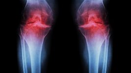 “Imagine being able to regenerate your own cartilage and avoid knee replacements.” Scientists have learned how to regenerate cartilage in knees and prevent arthritis without surgery: how it works