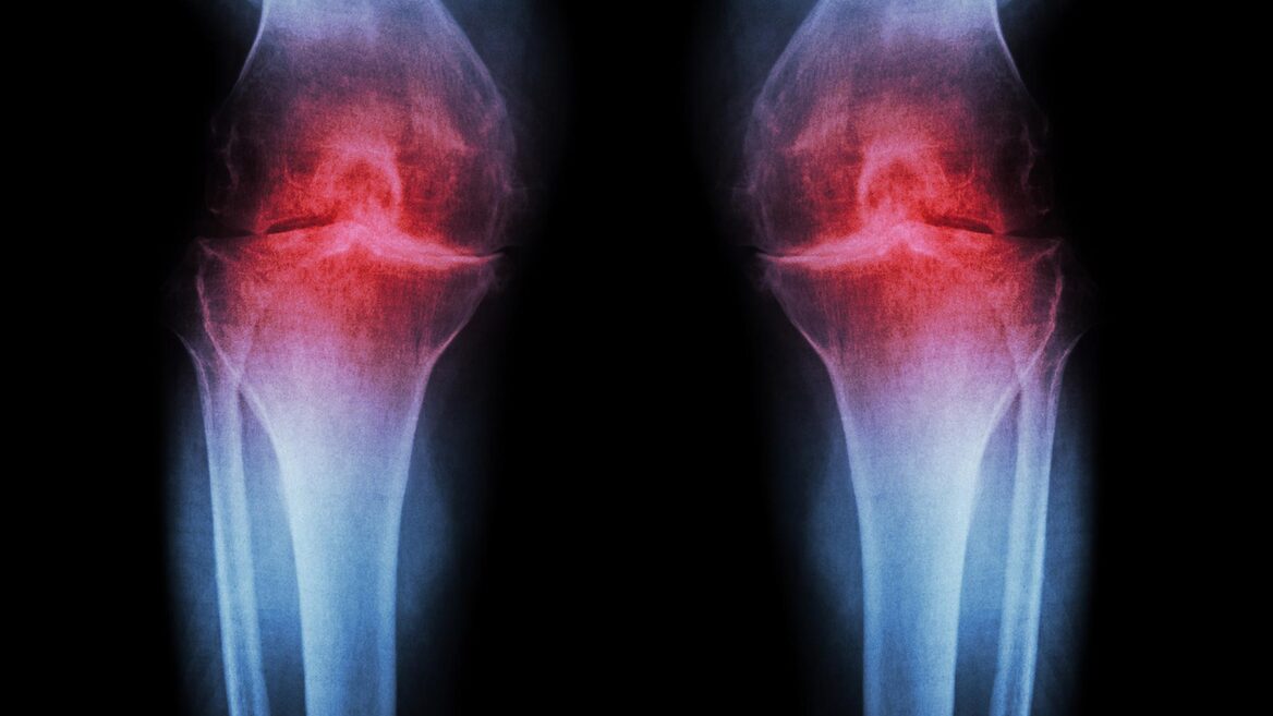 "Imagine being able to regenerate your own cartilage and avoid knee replacements." Scientists have learned to regenerate cartilage in the knees and prevent arthritis without surgery: how it works