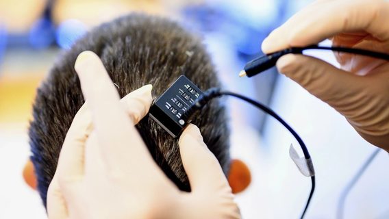 Жінка, яка не розмовляла 18 років після інсульту, знову заговорила завдяки мозково-комп'ютерному імплантату