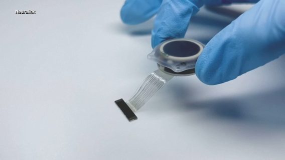Neuralink відклала вживлення чипа другому пацієнту. У чому причина